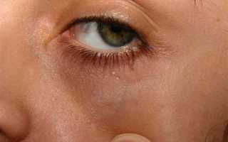 Избавляемся от жировиков на лице в домашних условиях