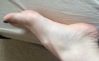 Шишка на стопе