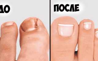 Как вылечить ногти