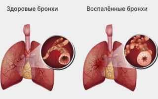 Как лечить бронхит у ребенка