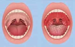 Как лечить герпесную ангину