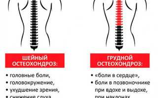 Симптомы шейного хондроза