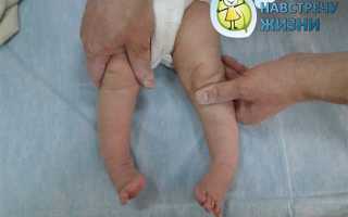 Как лечить косолапость
