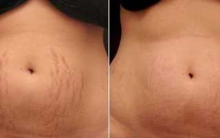 Как избавиться от растяжек на животе