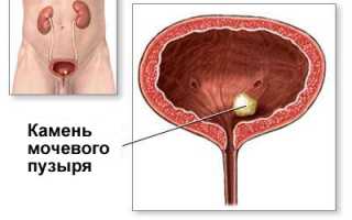 Симптомы камни в мочевом пузыре