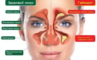 Ринит – гайморит, или что делать, если из носа течет желтая жидкость