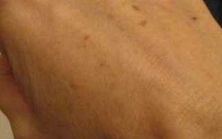 Что такое коричневые пятна на теле человека
