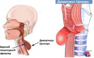 Ком в горле – тревожный симптом!