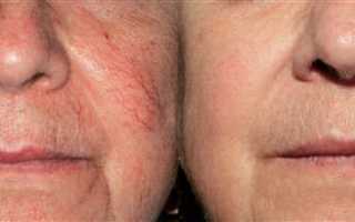 Как избавиться от сосудистых звездочек на лице