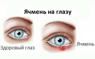 Методы быстрого излечения ячменя на глазу