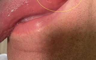 Лечение язвы на корне языка