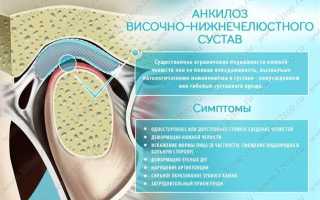 Анкилоз височно-нижнечелюстного сустава
