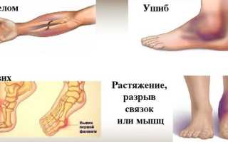 Как лечить растяжения и ушибы