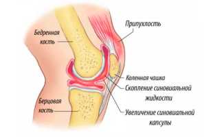 Жидкость в коленном суставе, что делать?
