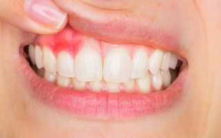 Чем лечить воспаление десен