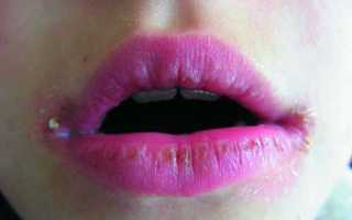 Как избавиться от заедов на губах