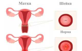 Симптомы эрозии шейки матки