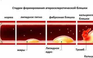 Почему развивается атеросклероз?