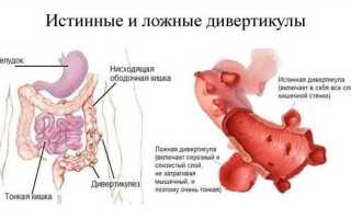 Как лечить сигмовидную кишку