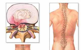Все о межпозвоночной грыже