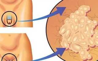 Какие бывают прыщи на головке