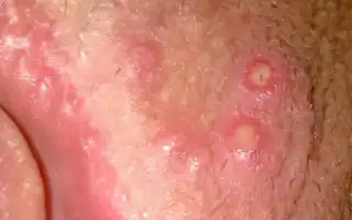 Причины мелких пузырьков на половых губах