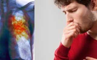 Индурированные очаги в легких что это