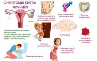 Симптомы кисты яичника