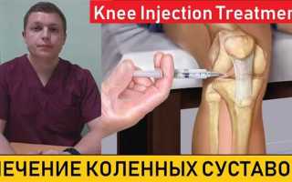 Использование хондропротекторов при артрозе коленного сустава
