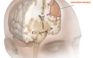 Минингиома головного мозга: всё, что нужно знать