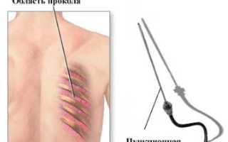 Биопсия при раке легкого