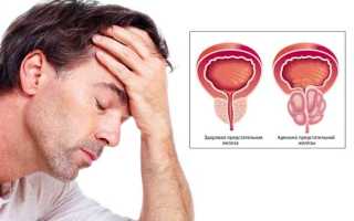 Как вылечить аденому простаты