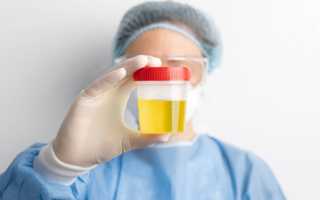 Что означает белый осадок в моче