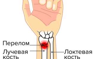 Перелом лучевой кости руки