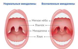 Как лечить горло и миндалины
