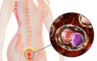 Симптомы хламидиоза у женщин