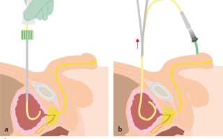Цистостома мочевого пузыря: симптомы, лечение, причины