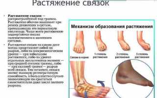 Чем лечить растяжение