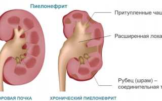 Симптомы пиелонефрита