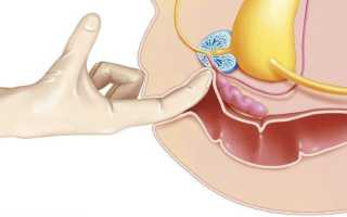 Как лечить простатит в домашних условиях