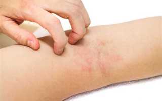 Симптомы дерматита