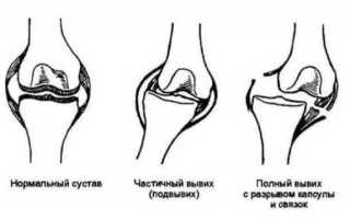 Что такое вывих, какими вывихи бывают