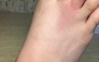 Как лечить ушиб пальца на ноге