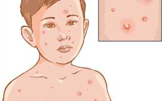 Что нужно знать о симптомах и методах лечения ветрянки