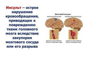 Причины и методы профилактики нарушений кровообращения в мозге