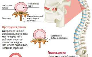 Как лечить грыжи спины