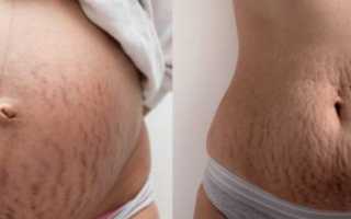 Как избавиться от растяжек после родов