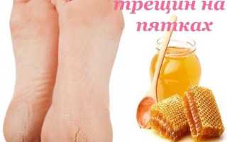 Как лечить треснувшие пятки
