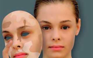 Народные методы лечения витилиго: эффективные способы избавиться от белых пятен