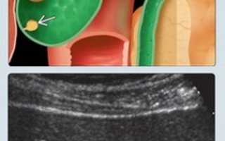 Как избавиться от полипа желчного пузыря